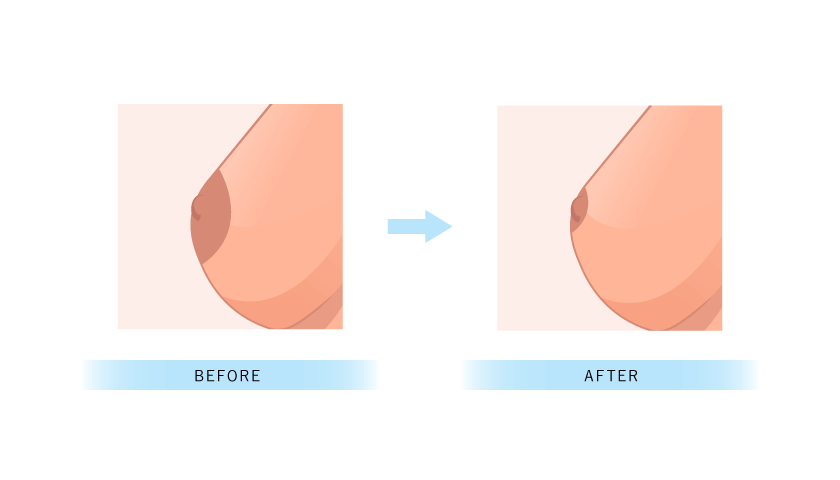 乳輪縮小術とは？